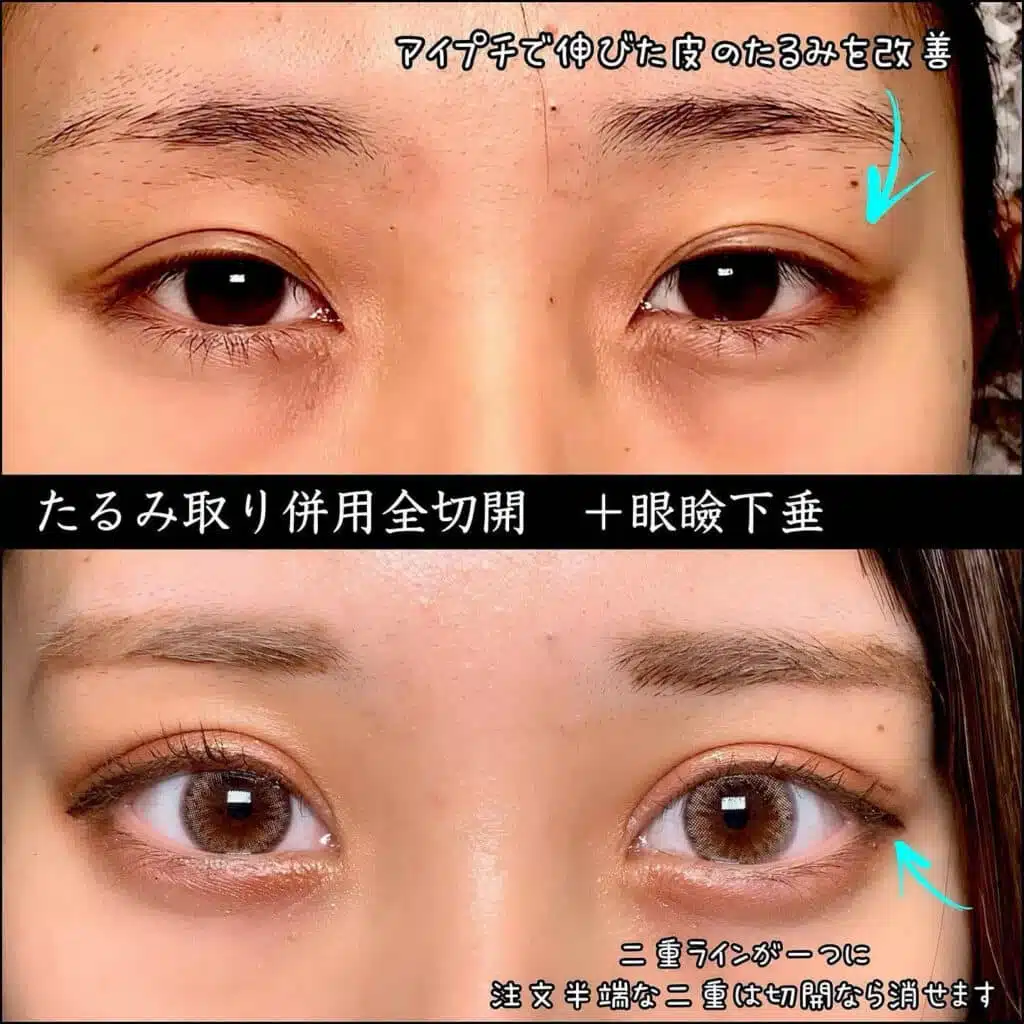 たるみ取り併用全切開+眼瞼下垂 横浜みなとみらい