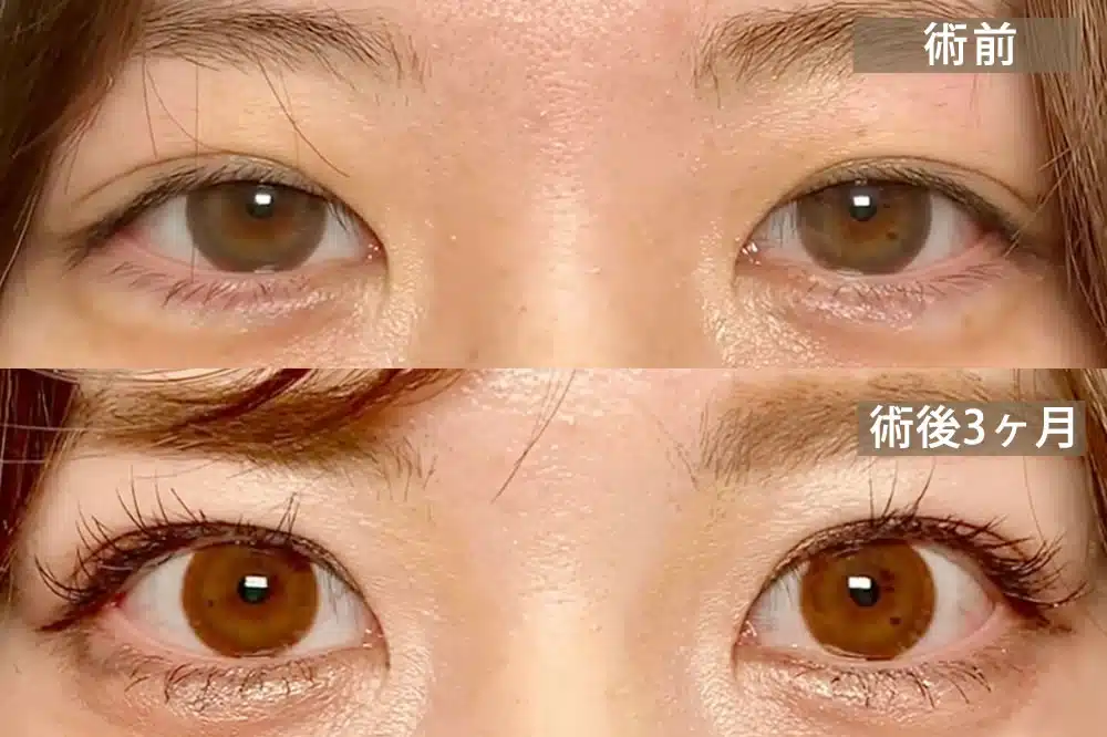 先天性眼瞼下垂 横浜みなとみらい