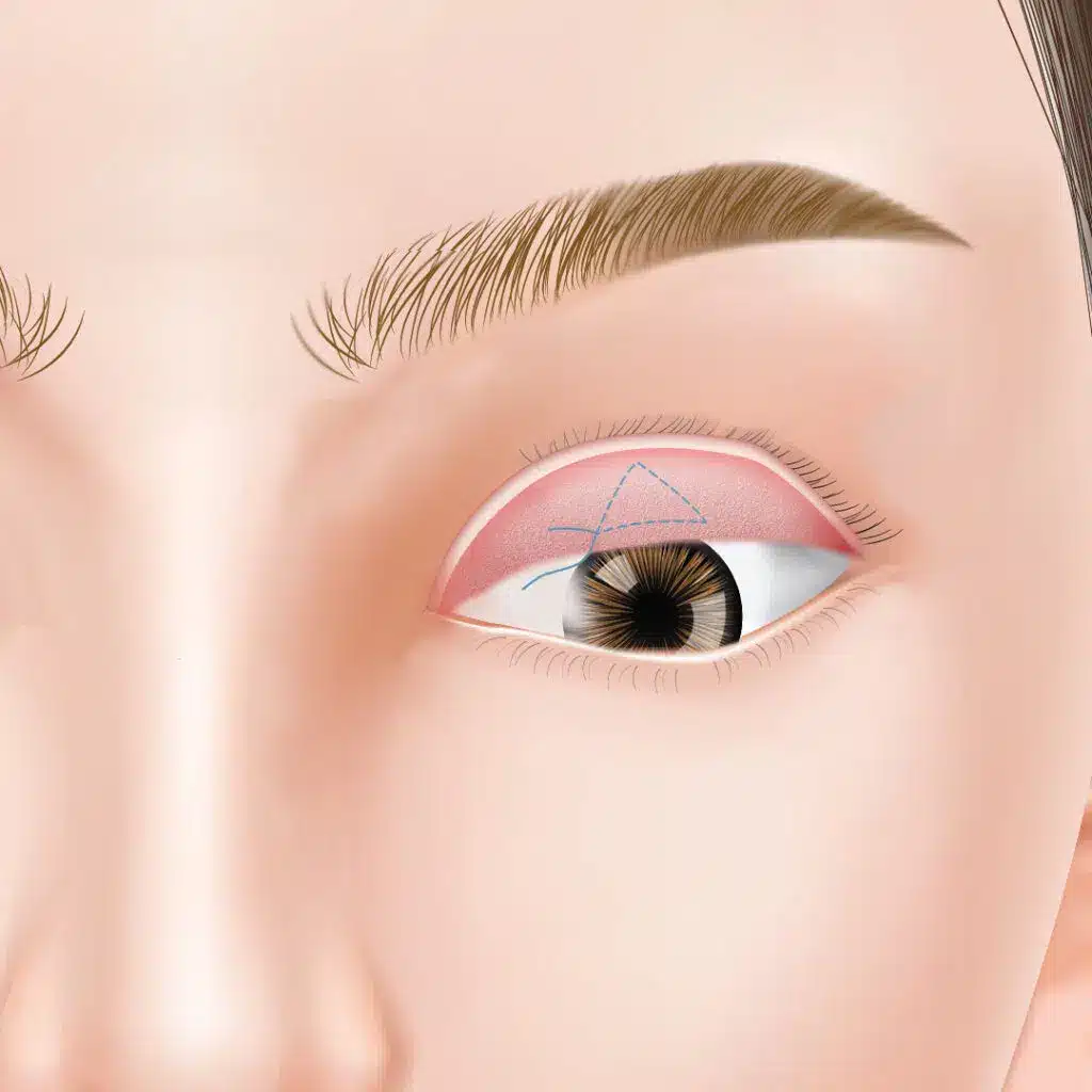 眼瞼下垂 手術方法 横浜みなとみらい