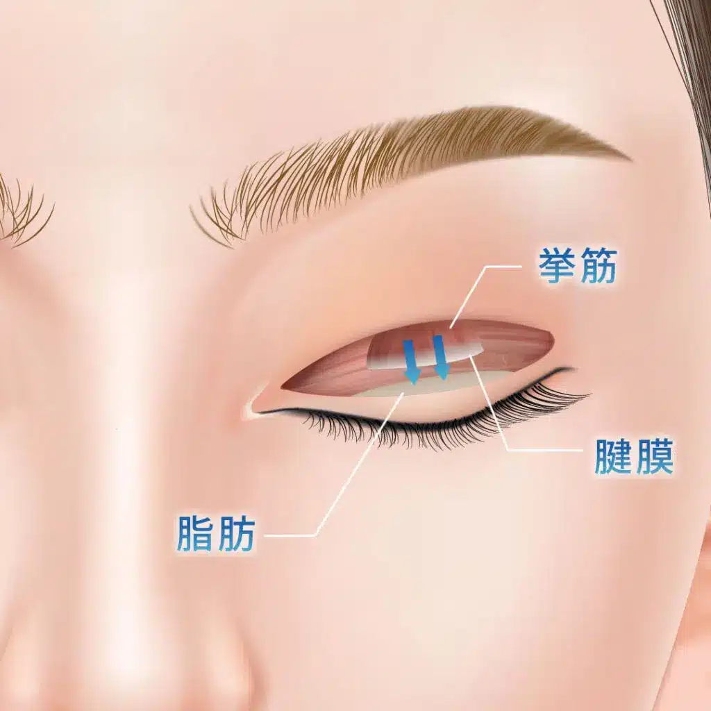 眼瞼下垂 手術方法 横浜みなとみらい