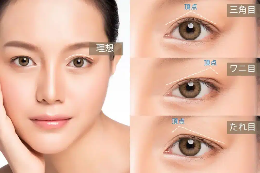 眼瞼下垂の失敗例の説明 横浜みなとみらい