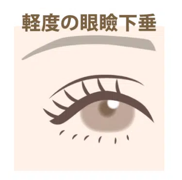 軽度の眼瞼下垂 横浜みなとみらい
