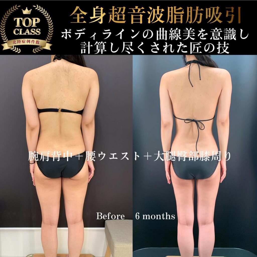 腕と肩と背中と腰とウエストと大腿と臀部と膝の超音波脂肪吸引の６ヶ月後の症例