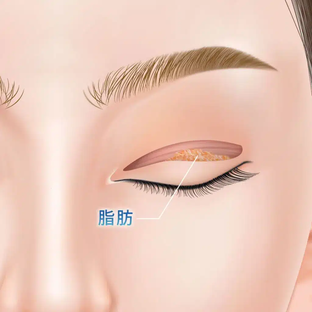眼瞼下垂 手術方法 横浜みなとみらい