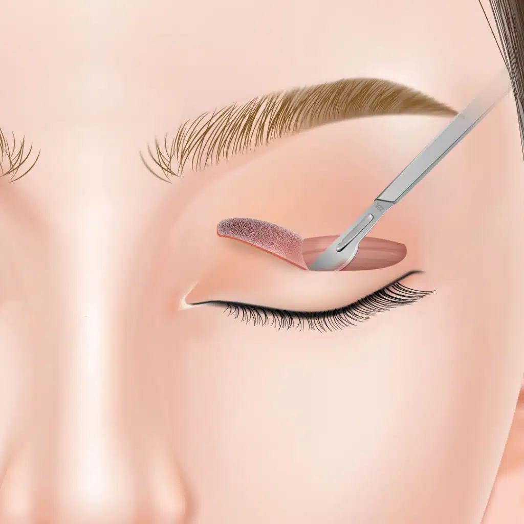 眼瞼下垂 手術方法 横浜みなとみらい