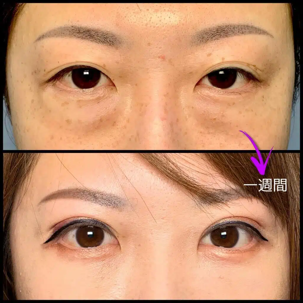 眼瞼下垂と全切開の傷跡の他院修正の1週間後の症例 横浜みなとみらい