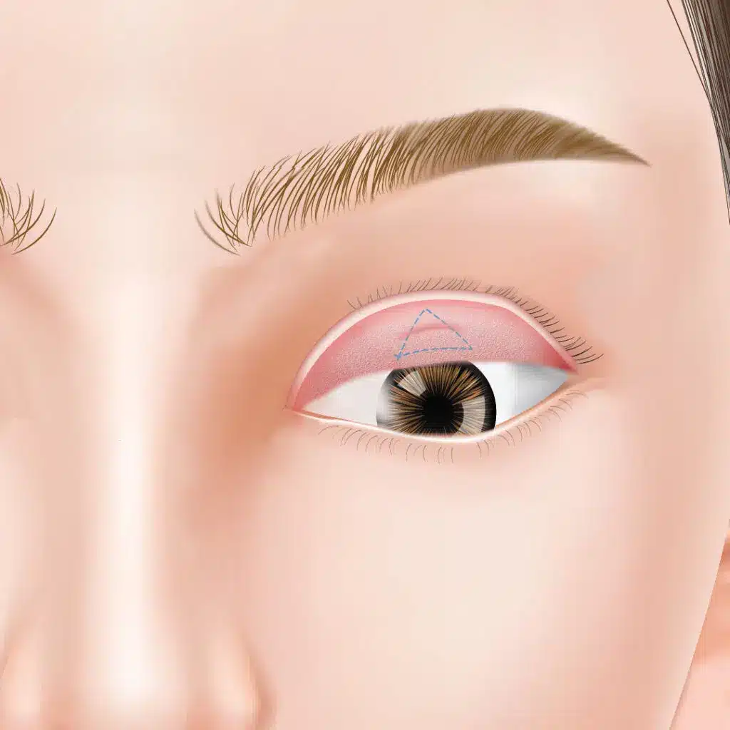 眼瞼下垂 手術方法 横浜みなとみらい