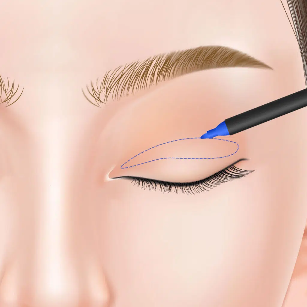 眼瞼下垂 手術方法 横浜みなとみらい