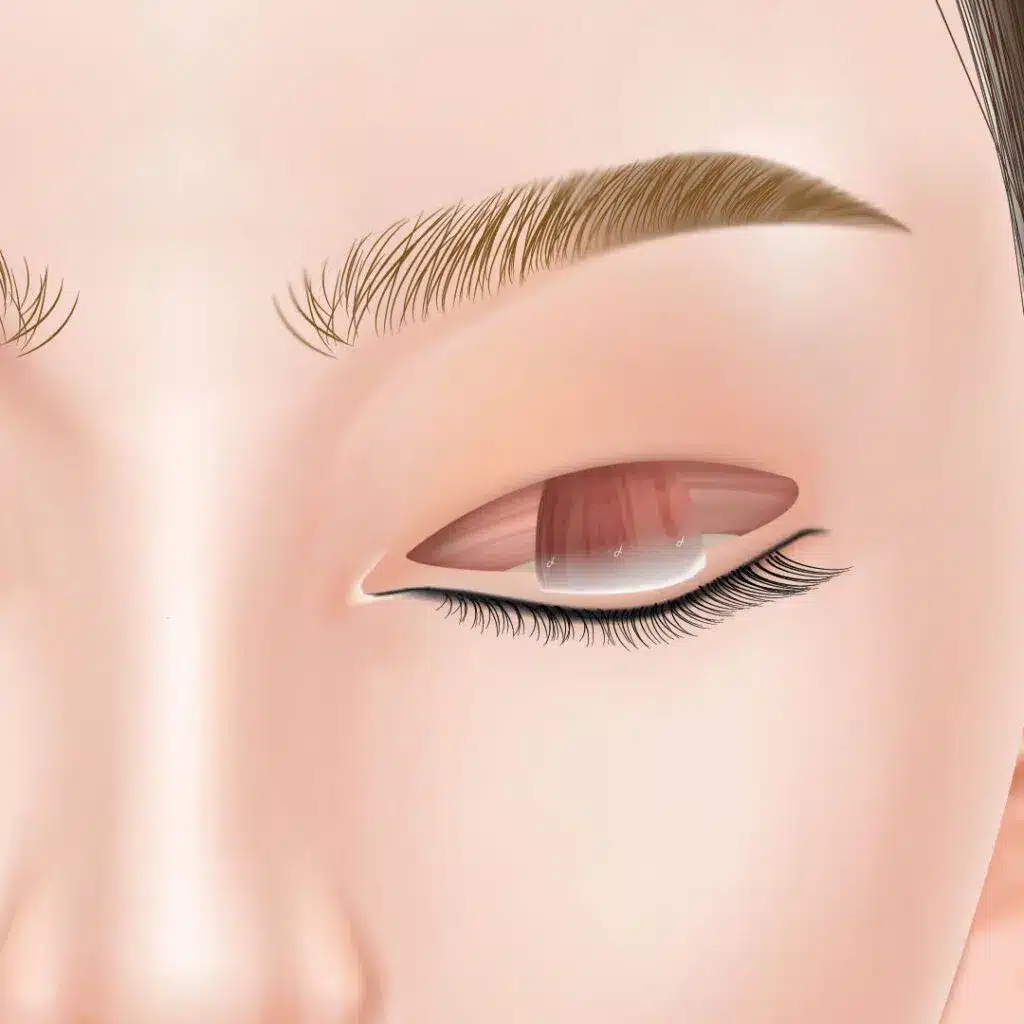 眼瞼下垂 手術方法 横浜みなとみらい