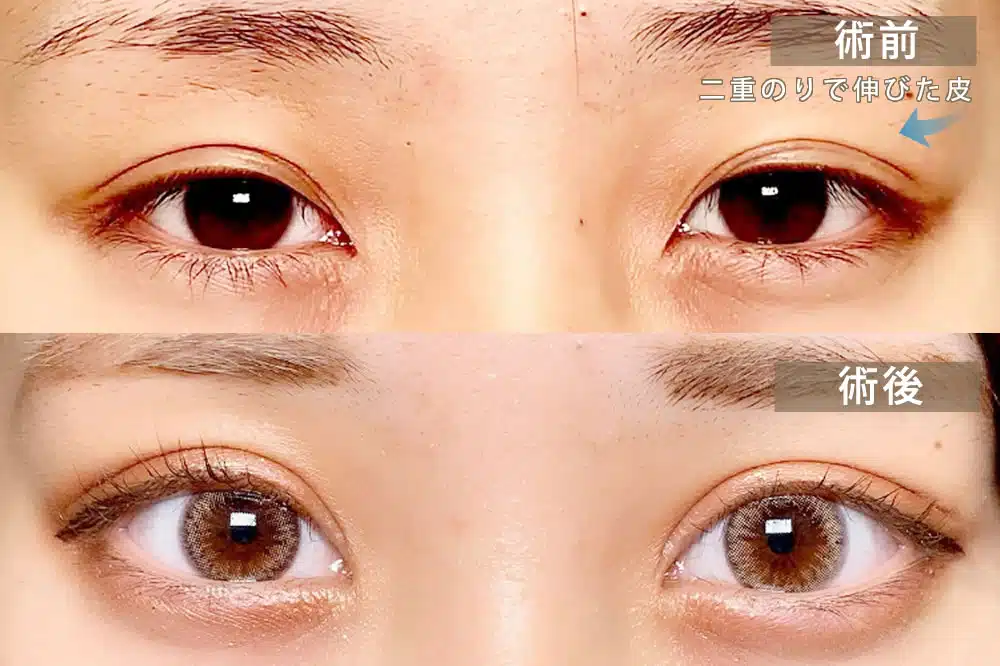 偽眼瞼下垂 横浜みなとみらい