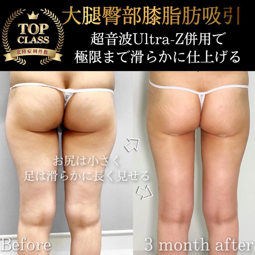 張田医師が行った太腿とお尻と膝の超音波脂肪吸引の３か月後の症例