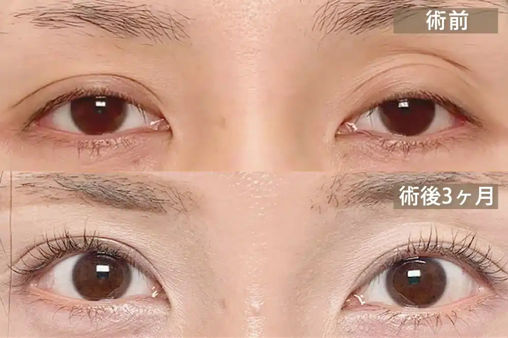 腱膜性眼瞼下垂(後天性眼瞼下垂) 横浜みなとみらい