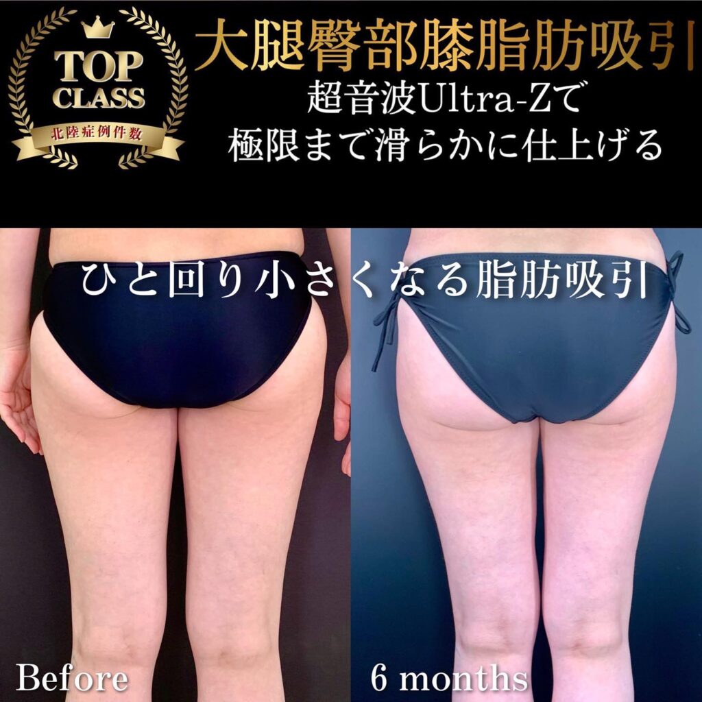 大腿と臀部と膝の超音波脂肪吸引の６ヶ月後の症例