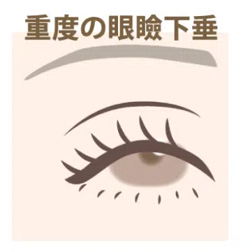 重度の眼瞼下垂 横浜みなとみらい