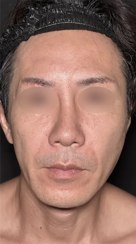 鼻整形_鼻尖形成オープン法+鼻尖軟骨移植+鼻プロテーゼ+鼻翼縮小内外側引き締め法術前(名医の坂本優衣医師が執刀)(158)