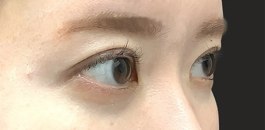 二重整形_二重全切開(切開時埋没抜糸)術後3ヶ月横(名医の飯田秀夫医師が執刀)(84)