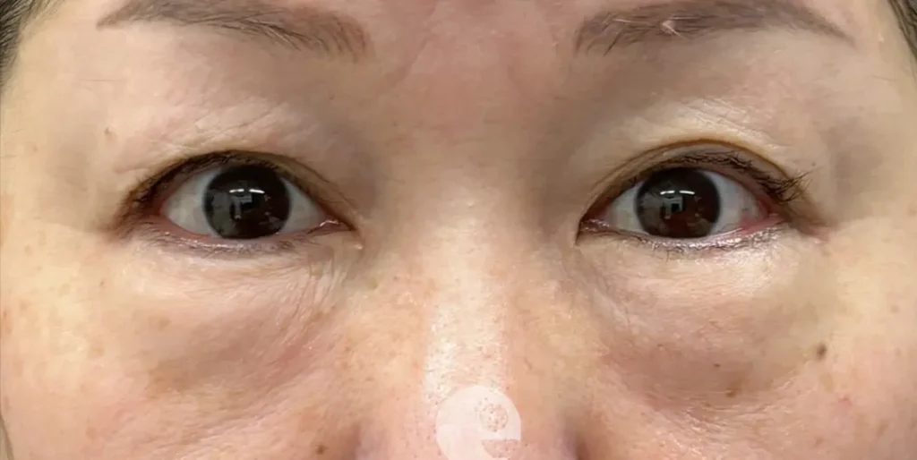 クマ取り_表ハムラ法他院修正術前（名医の飯田秀夫が執刀）（88）