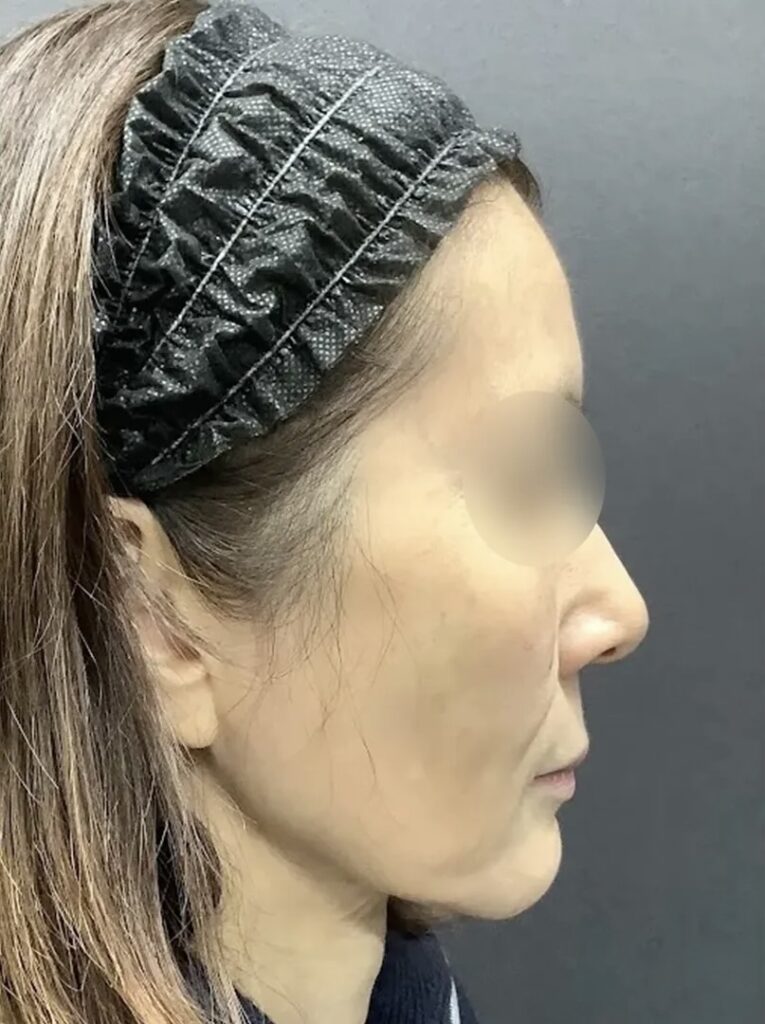 フェイスリフトスマス＋ネックリフト＋ミッドフェイスリフト＋こめかみリフト術前_名医の飯田秀夫医師が執刀