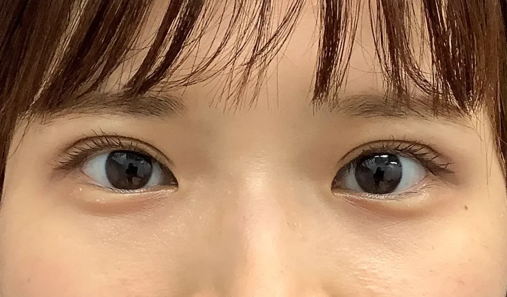 二重整形＋眼瞼下垂_たるみ取り併用全切開二重術＋軽度眼瞼下垂術後3ヶ月（名医の飯田秀夫医師が執刀）（85）