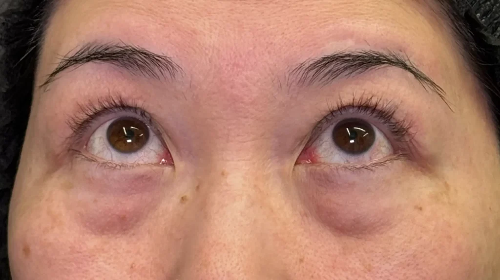 クマ取り_裏ハムラ法術前目上(名医の坂本優衣医師が執刀)(32)