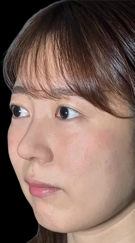 鼻整形_鼻尖形成オープン法＋鼻尖軟骨移植＋鼻柱下降術後横（坂本優衣）（159）