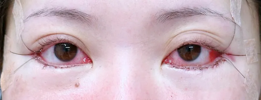 目元切開_（グラマラスライン形成）目尻切開＋タレ目形成皮膚＋結膜（名医の坂本優衣が執刀）（28）