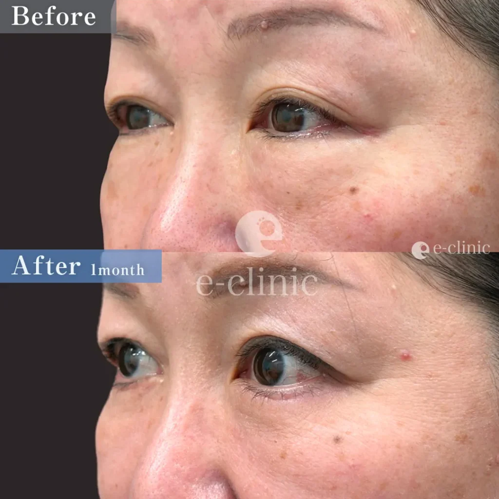 クマ取り_表ハムラ法他院修正（飯田秀夫）（88）