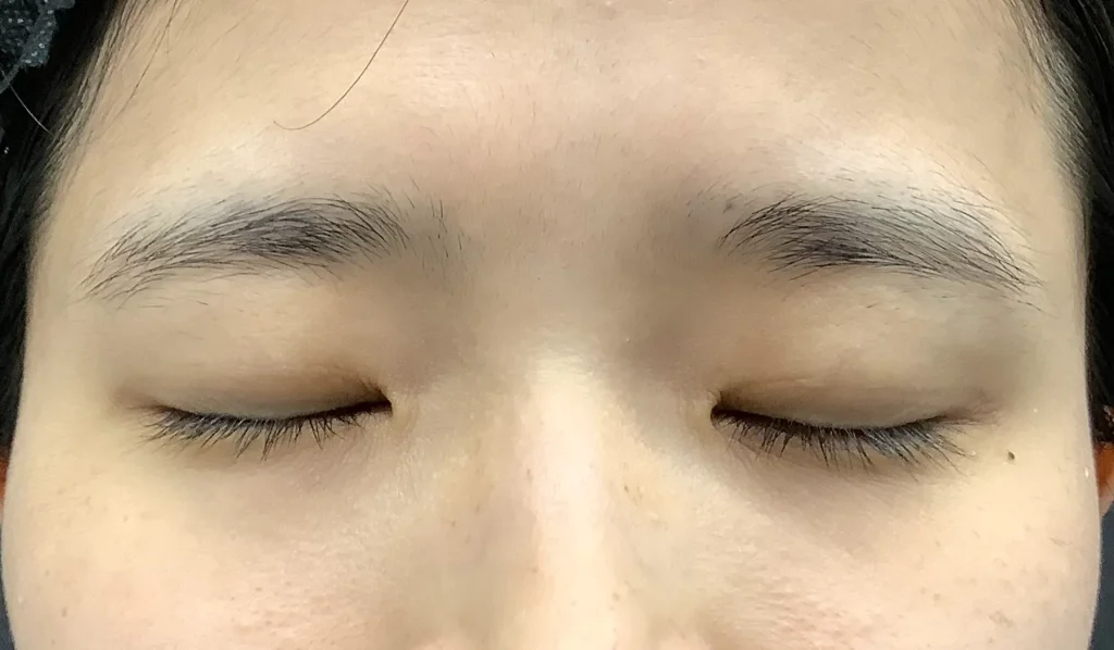 二重整形＋眼瞼下垂_たるみ取り併用全切開二重術＋軽度眼瞼下垂術前閉眼（名医の飯田秀夫医師が執刀）（85）