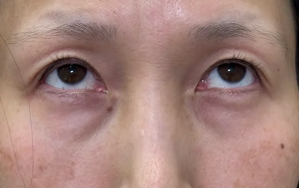 eクリニック横浜みなとみらい院のクマ取り施術 経結膜脱脂+脂肪注入(コンデンス+ナノリッチ)の施術前の症例写真(名医の坂本優衣医師が執刀)