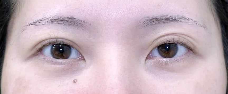 目元切開_（グラマラスライン形成）目尻切開＋タレ目形成皮膚＋結膜（名医の坂本優衣が執刀）（28）