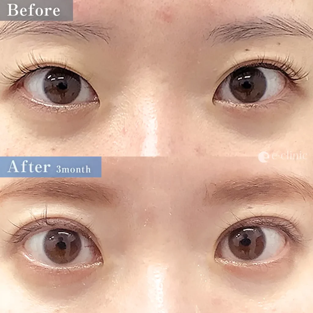 二重整形_二重全切開（切開時埋没抜糸）（飯田秀夫）（84）