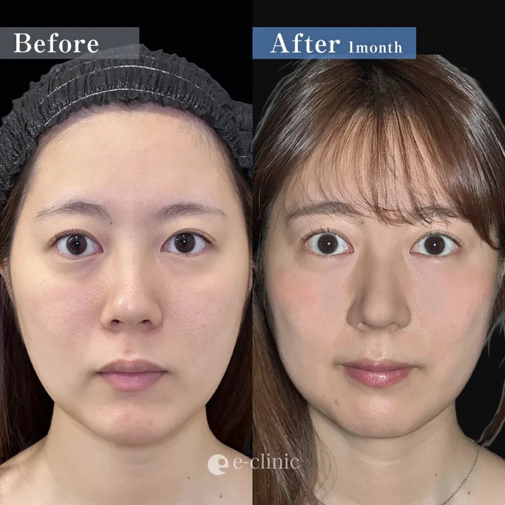 鼻整形_鼻尖形成オープン法＋鼻尖軟骨移植＋鼻柱下降（坂本優衣）（159）