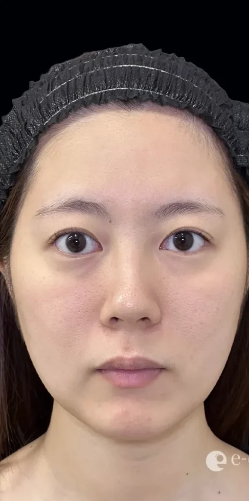 鼻整形_鼻尖形成オープン法＋鼻尖軟骨移植＋鼻柱下降術前（坂本優衣）（159）