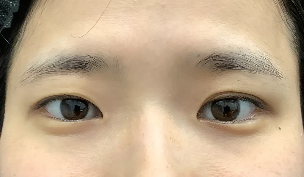 二重整形＋眼瞼下垂_たるみ取り併用全切開二重術＋軽度眼瞼下垂術前（名医の飯田秀夫医師が執刀）（85）