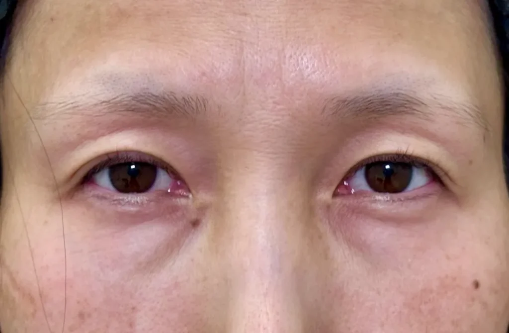 eクリニック横浜みなとみらい院のクマ取り施術 経結膜脱脂+脂肪注入(コンデンス+ナノリッチ)の施術前の症例写真(名医の坂本優衣医師が執刀)