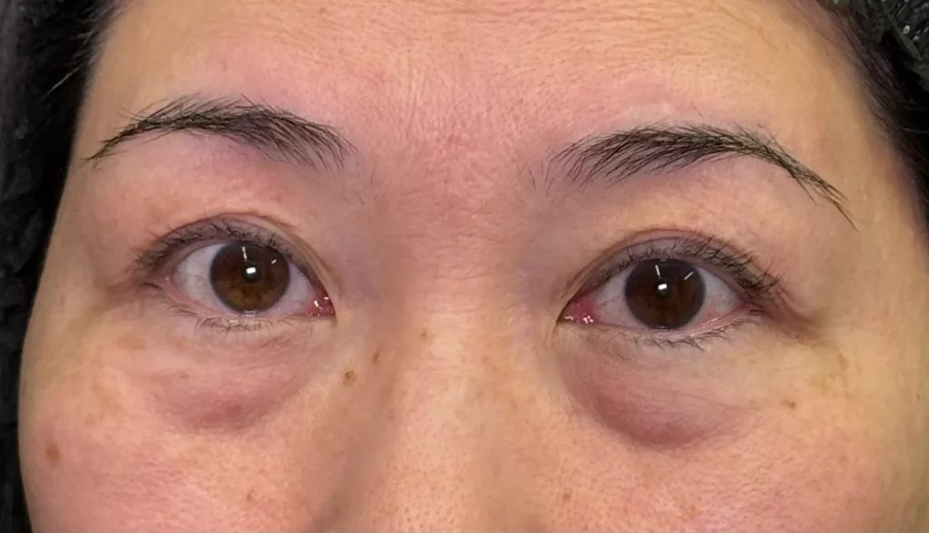 クマ取り_裏ハムラ法術前(名医の坂本優衣医師が執刀)(32)