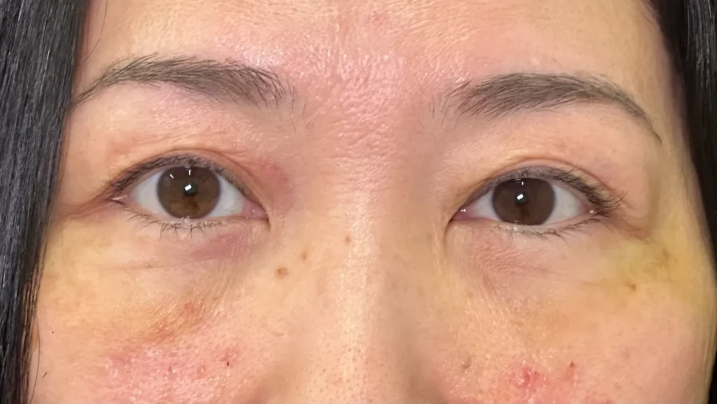 クマ取り_裏ハムラ法術後1週間(名医の坂本優衣医師が執刀)(32)