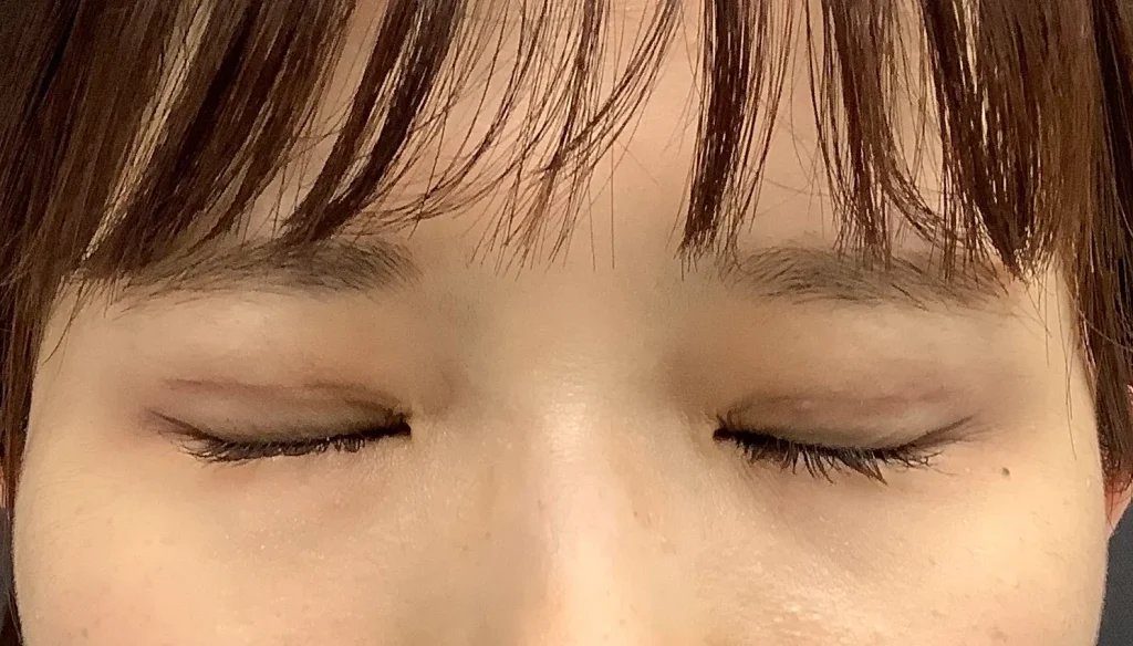 二重整形＋眼瞼下垂_たるみ取り併用全切開二重術＋軽度眼瞼下垂術後3ヶ月閉眼（名医の飯田秀夫医師が執刀）（85）