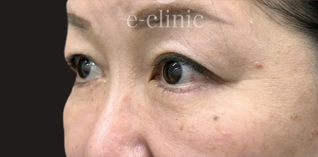 クマ取り_表ハムラ法他院修正術後1ヶ月横（名医の飯田秀夫が執刀）（88）