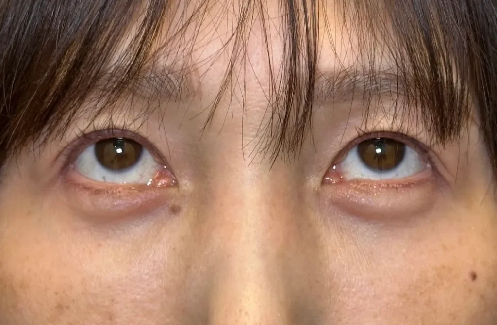 eクリニック横浜みなとみらい院のクマ取り施術 経結膜脱脂+脂肪注入(コンデンス+ナノリッチ)の術後1ヶ月の症例写真(名医の坂本優衣医師が執刀)