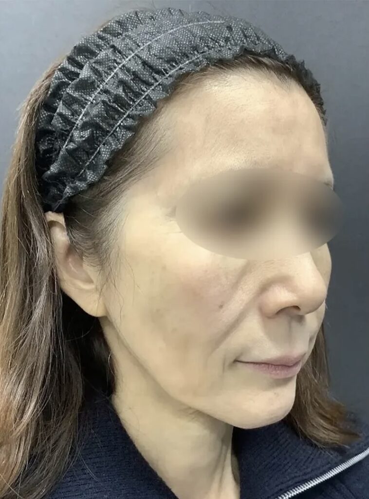 フェイスリフトスマス＋ネックリフト＋ミッドフェイスリフト＋こめかみリフト術前_名医の飯田秀夫医師が執刀