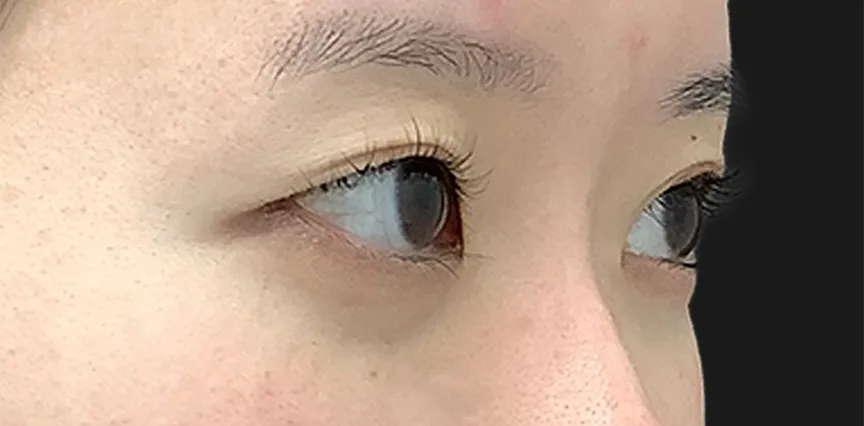 二重整形_二重全切開(切開時埋没抜糸)術前横(名医の飯田秀夫医師が執刀)(84)