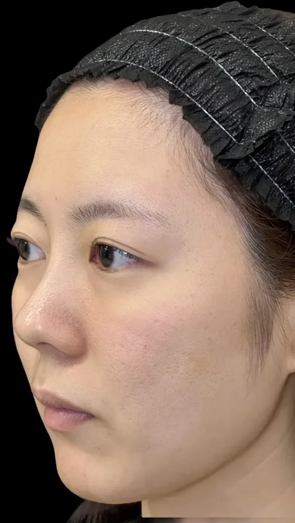 鼻整形_鼻尖形成オープン法＋鼻尖軟骨移植＋鼻柱下降術前横（坂本優衣）（159）