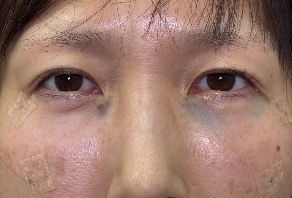 eクリニック横浜みなとみらい院のクマ取り施術 経結膜脱脂+脂肪注入(コンデンス+ナノリッチ)の施術直後の症例写真(名医の坂本優衣医師が執刀)