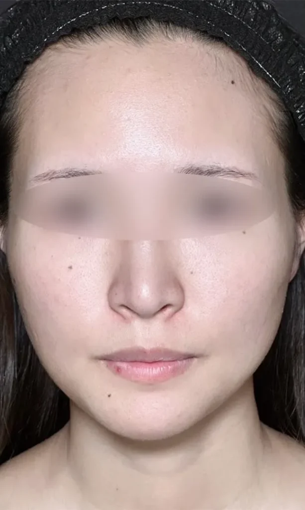 鼻尖形成オープン法＋鼻尖軟骨移植＋鼻プロテーゼ術前（名医の坂本優衣医師が執刀）（160）