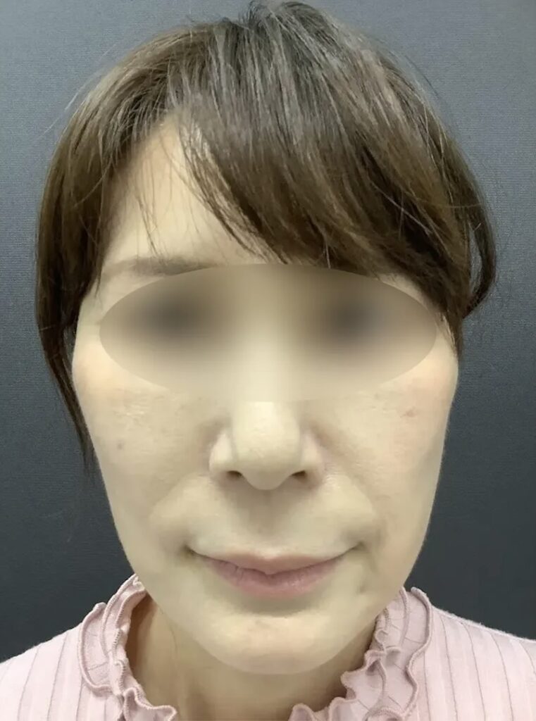 フェイスリフトスマス＋ネックリフト＋ミッドフェイスリフト＋こめかみリフト術後1ヶ月_名医の飯田秀夫医師が執刀