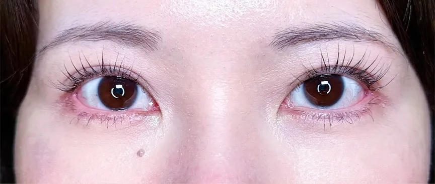 目元切開_（グラマラスライン形成）目尻切開＋タレ目形成皮膚＋結膜（名医の坂本優衣が執刀）（28）