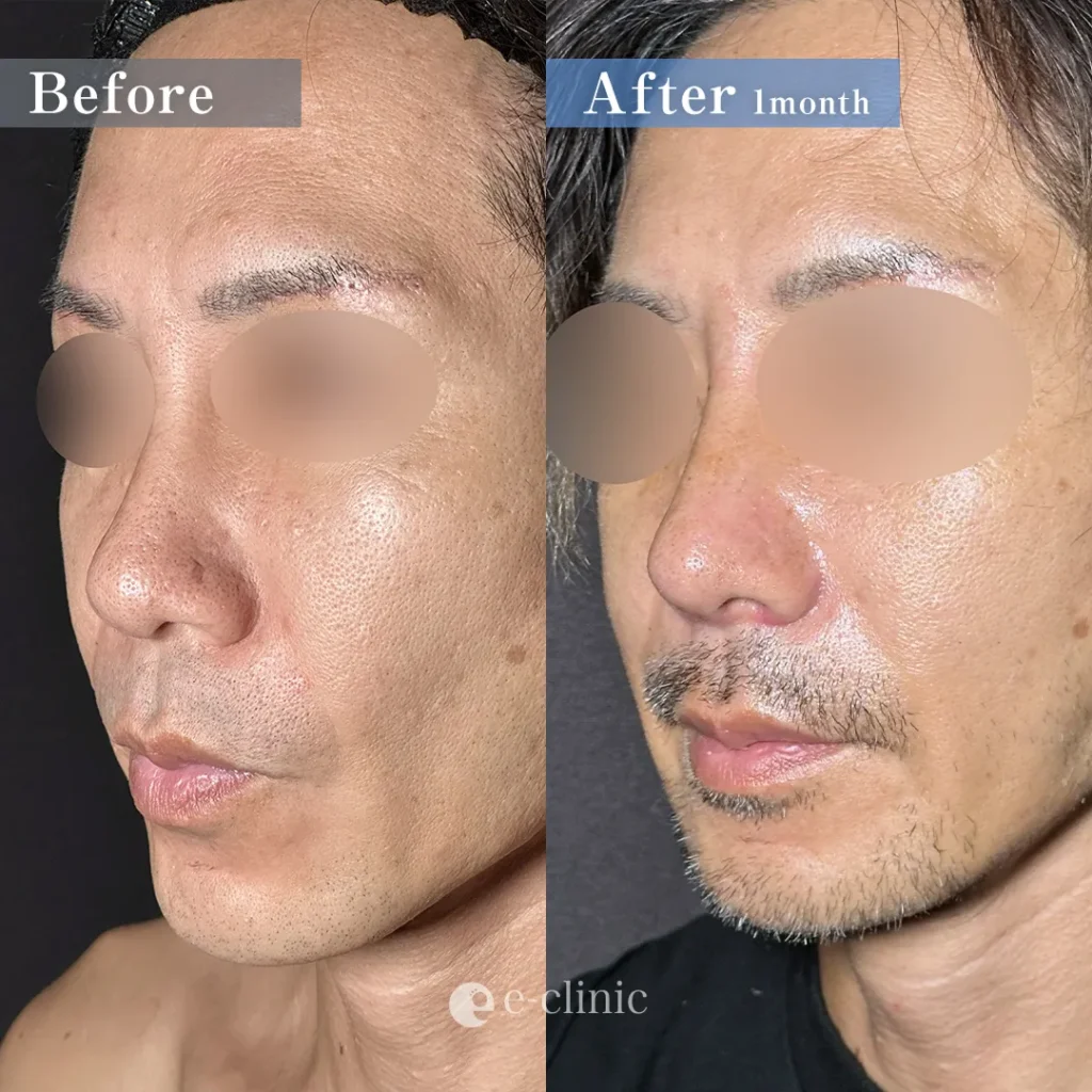 鼻整形_鼻尖形成オープン法+鼻尖軟骨移植+鼻プロテーゼ+鼻翼縮小内外側引き締め法（坂本優衣）（158）