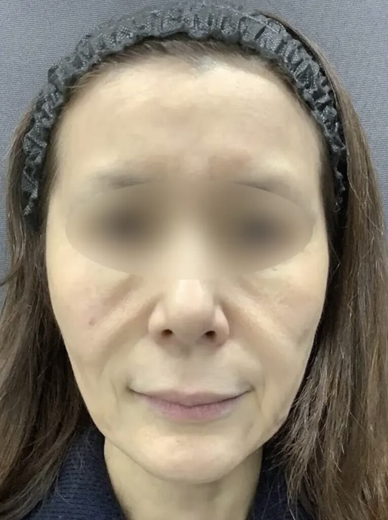 フェイスリフトスマス＋ネックリフト＋ミッドフェイスリフト＋こめかみリフト術前_名医の飯田秀夫医師が執刀