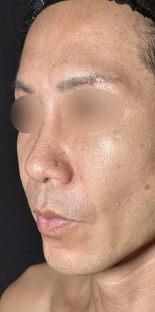 鼻整形_鼻尖形成オープン法+鼻尖軟骨移植+鼻プロテーゼ+鼻翼縮小内外側引き締め法術前横(名医の坂本優衣医師が執刀)(158)